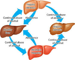 Preventive Measures For Cirrhosis Of Liver And Its Progression